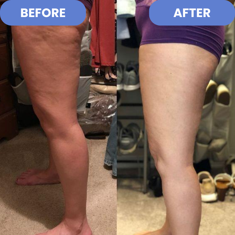 Velina™ - Anti-Cellulite-Entferner | 50 % RABATT
