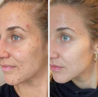 Kurkuma-Serum™ Korrektur von dunklen Flecken